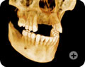 10x10 Implant