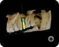 Implant